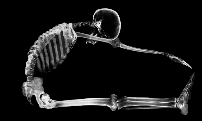 bone-fracture-blog-posts-2021-02.jpg